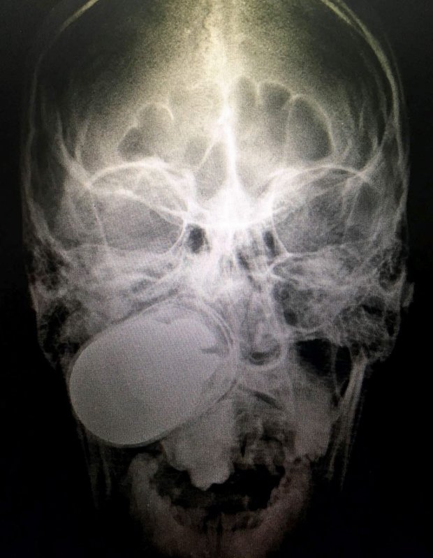 epa05354647 A handout image made avaiable on 10 June 2016 and released by the Colombia Military Hospital on 09 June 2016, showing the X-Ray of the skull of Colombian soldier Leandro Jose Luna with a grenade in his face after suffering an accident on duty in Colombia, next to the border with Venezuela. The grenade was removed sucessfully by medical staff in the car park of the hospital because of the fear that the grenade could explode at the operating room.  EPA/COLOMBIAN MILITARY HOSPITAL / HANDOUT  HANDOUT EDITORIAL USE ONLY/NO SALES